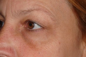 Upper and Lower Eyelid Blepharoplasty with Laser Resurfacing