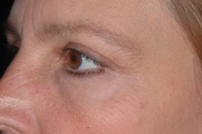 Upper and Lower Eyelid Blepharoplasty with Laser Resurfacing