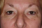 Upper and Lower Eyelid Blepharoplasty with Laser Resurfacing