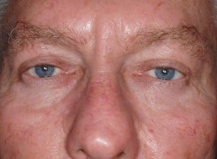 Patient 122 - After View 