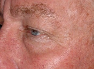 Patient 122 - Before View 