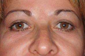 Upper and Lower Eyelid Blepharoplasty with Laser Resurfacing