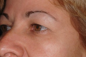 Upper and Lower Eyelid Blepharoplasty with Laser Resurfacing