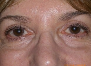 Patient 125 - After View 
