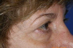 Upper and Lower Eyelid Blepharoplasty with Laser Resurfacing