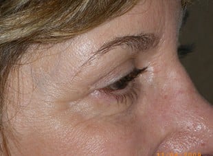 Patient 125 - After View 