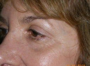 Patient 125 - After View 