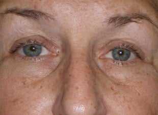 Patient 127 - Before View 