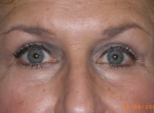 Patient 127 - After View 