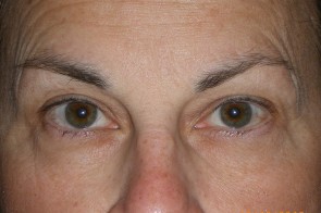 Upper and Lower Eyelid Blepharoplasty with Laser Resurfacing