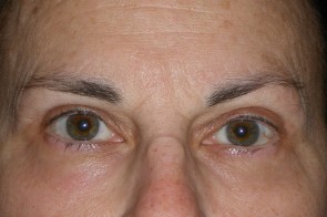 Upper and Lower Eyelid Blepharoplasty with Laser Resurfacing