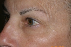 Upper and Lower Eyelid Blepharoplasty with Laser Resurfacing