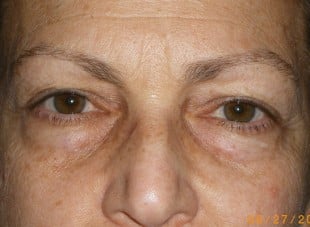 Patient 133 - Before View 