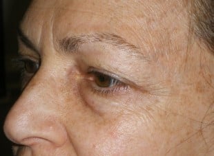 Patient 133 - Before View 