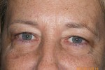 Upper and Lower Eyelid Blepharoplasty with Laser Resurfacing