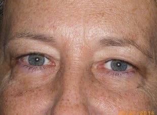 Patient 136 - Before View 