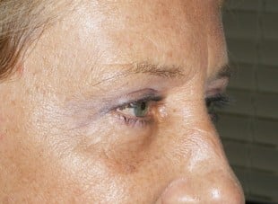 Patient 136 - After View 