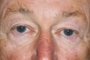 Upper and Lower Eyelid Blepharoplasty with Laser Resurfacing