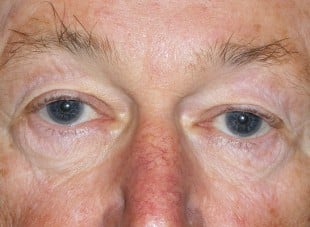 Patient 138 - Before View 
