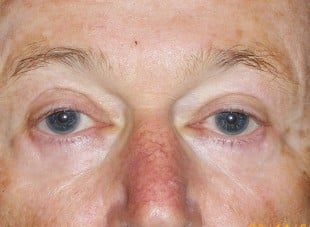 Patient 138 - After View 
