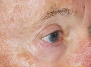 Patient 138 - After View 