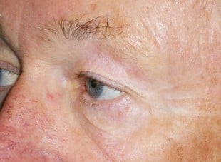 Patient 138 - Before View 