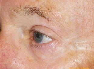Patient 138 - After View 