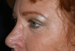 Ptosis Surgery with Blepharoplasty