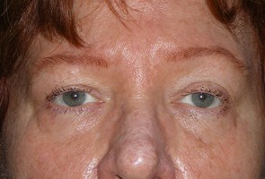 Ptosis Surgery with Blepharoplasty