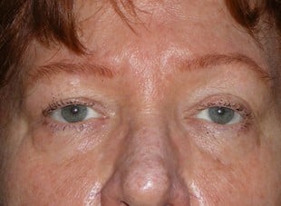 Patient 16 - Before View 