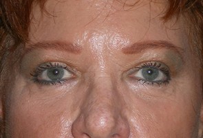 Ptosis Surgery with Blepharoplasty