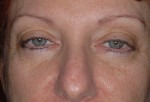 Ptosis Surgery with Blepharoplasty