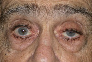 Ptosis Surgery with Blepharoplasty