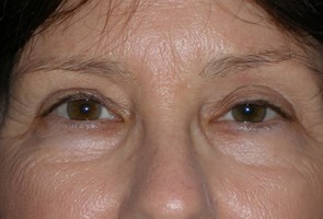 Ptosis Surgery with Blepharoplasty