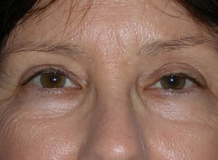 Patient 33 - Before View 