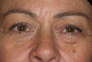 Ptosis Surgery with Blepharoplasty