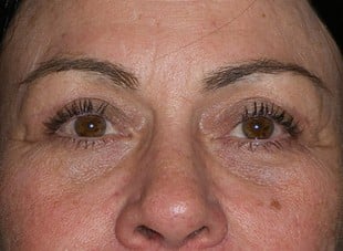 Patient 39 - After View 