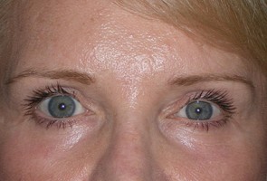 Ptosis Surgery with Blepharoplasty