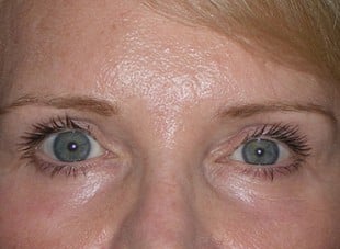 Patient 46 - After View 