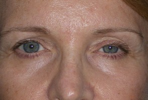 Ptosis Surgery with Blepharoplasty