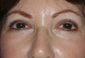 Ptosis Surgery with Blepharoplasty