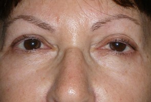 Ptosis Surgery with Blepharoplasty