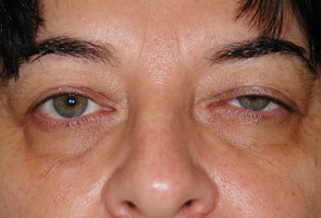 Ptosis Surgery with Blepharoplasty