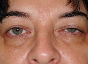 Patient 55 - Before View 