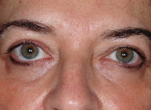 Patient 55 - After View 