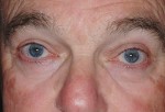 Ptosis Surgery with Blepharoplasty