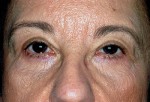 Ptosis Surgery with Blepharoplasty