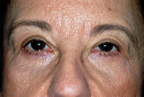 Ptosis Surgery with Blepharoplasty