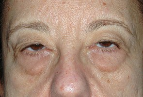 Ptosis Surgery with Blepharoplasty