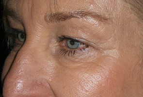 Ptosis Surgery with Blepharoplasty